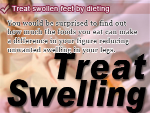 Treat swollen feet by dieting