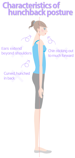 Characteristics of flat back posture