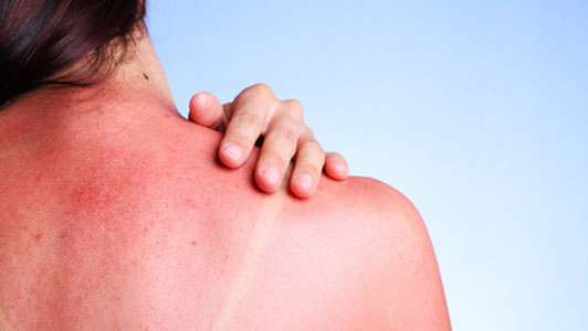 sunburnt woman with hand on shoulder