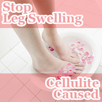 Stop Leg Swelling